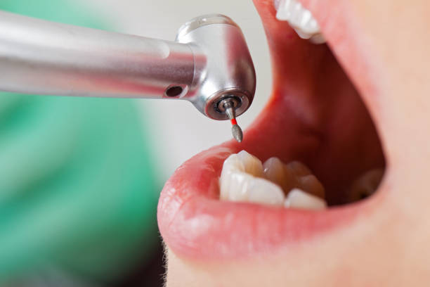 Best Emergency Tooth Extraction in Jefferson, WI